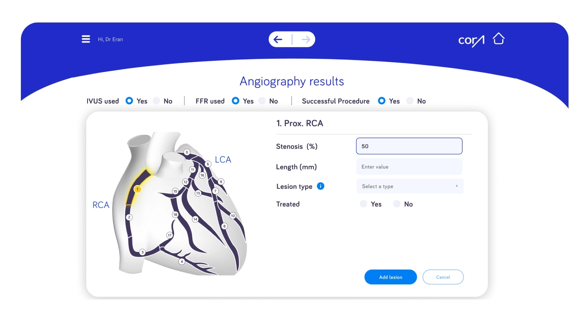 CORA angiography results form with a coronary artery diagram and lesion details.